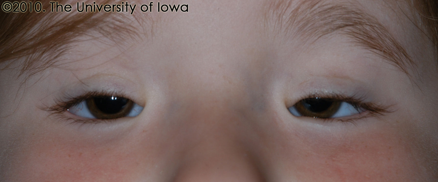 Young child suffering from Blepharophimosis