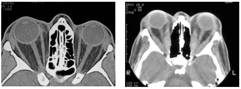 TED can manifest with proptosis secondary to expansion of fat, seen as dark areas around the eye muscles
