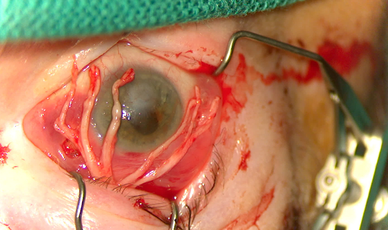 graphic representation of corneal neurotization