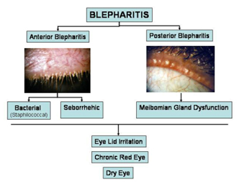 Blepharitis Flow Chart
