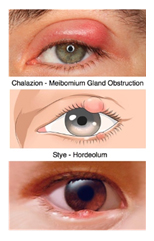 Examples of stye and chalazion