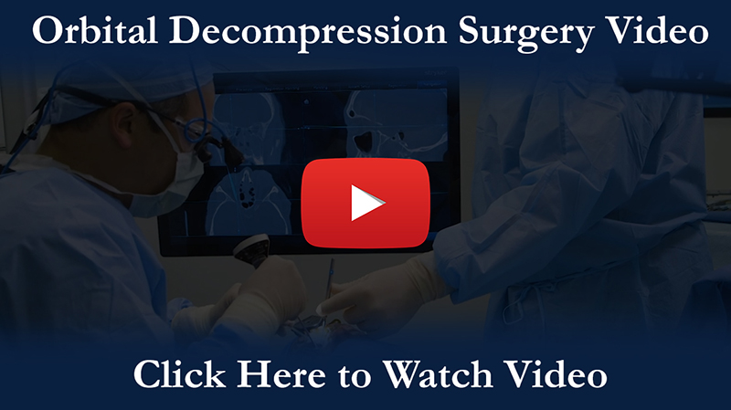 Orbital Decompression Video Thumbnail