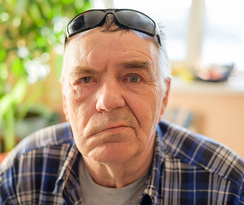 Aged man with facial nerve paralysis, Bell's palsy