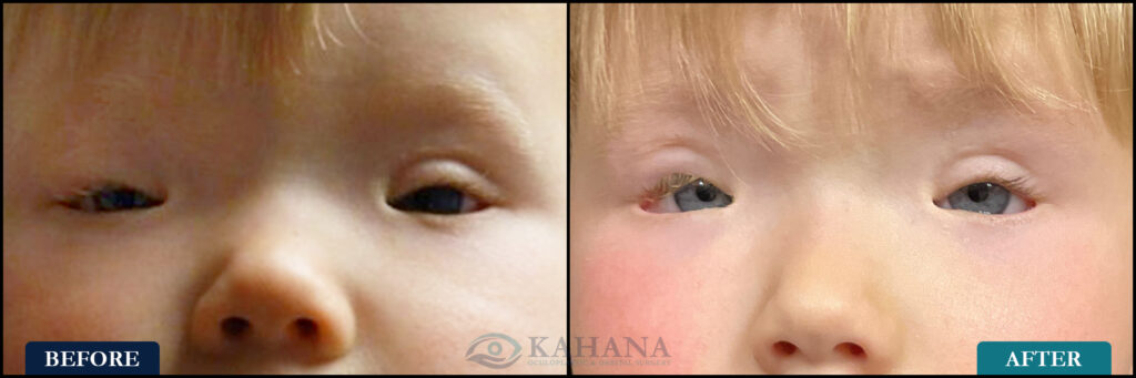 Aksel_Before&After_Web_Layout