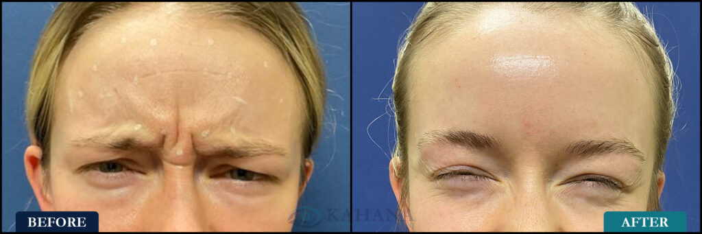 AlexandriaBrowFurrow_Before&After_Web_Layout