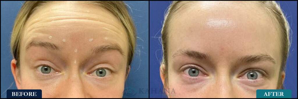 AlexandriaBrowRaise_Before&After_Web_Layout