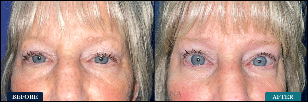 Barbara_Before&After_Web_Layout