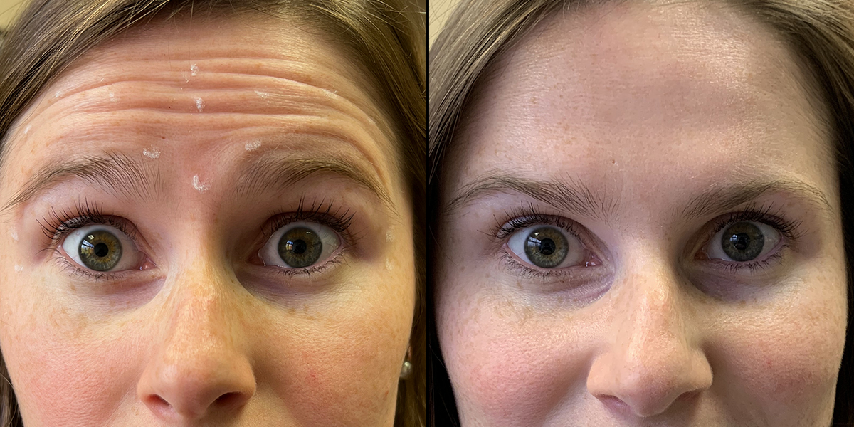 Botox Before & After Photo