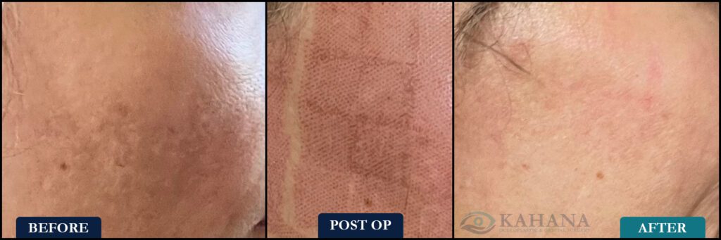 NEW_CO2_Laser_Before&After