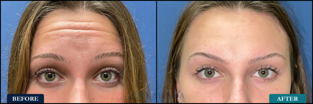 OliviaBrowFurrow_Before&After_Web_Layout