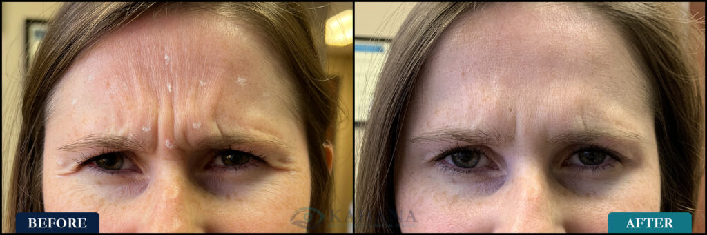 SaraBrowFurrow_Before&After_Web_Layout