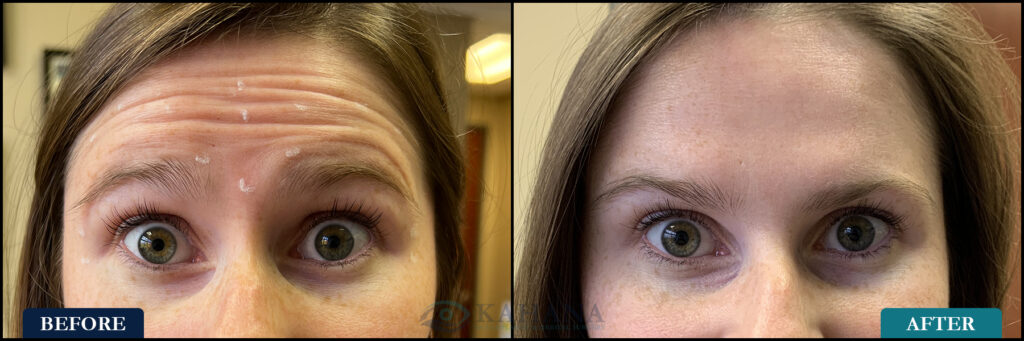 SaraBrowRaise_Before&After_Web_Layout